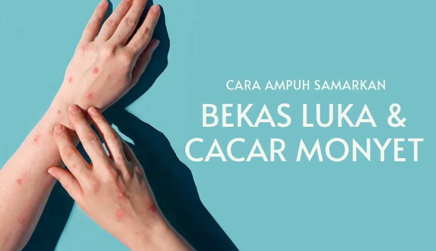 8 Cara ampuh hilangkan luka cacar monyet, No More Insecure!