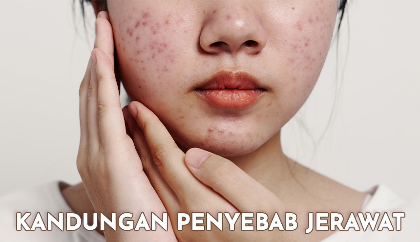 Kandungan Skincare yang Bikin Jerawatan, Kamu Wajib Tahu!