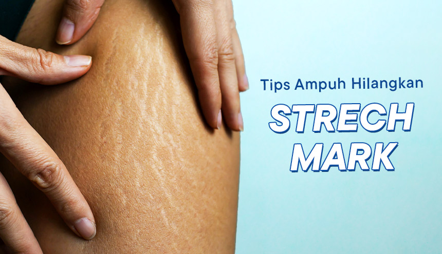 Wajib Tahu! 6 Tips Ampuh Hilangkan Stretch Mark