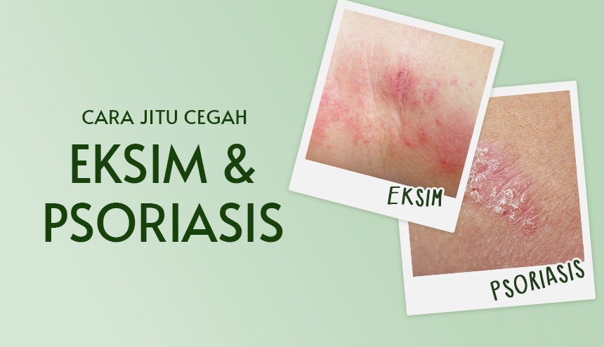 cara mencegah eksim dan psoriasis